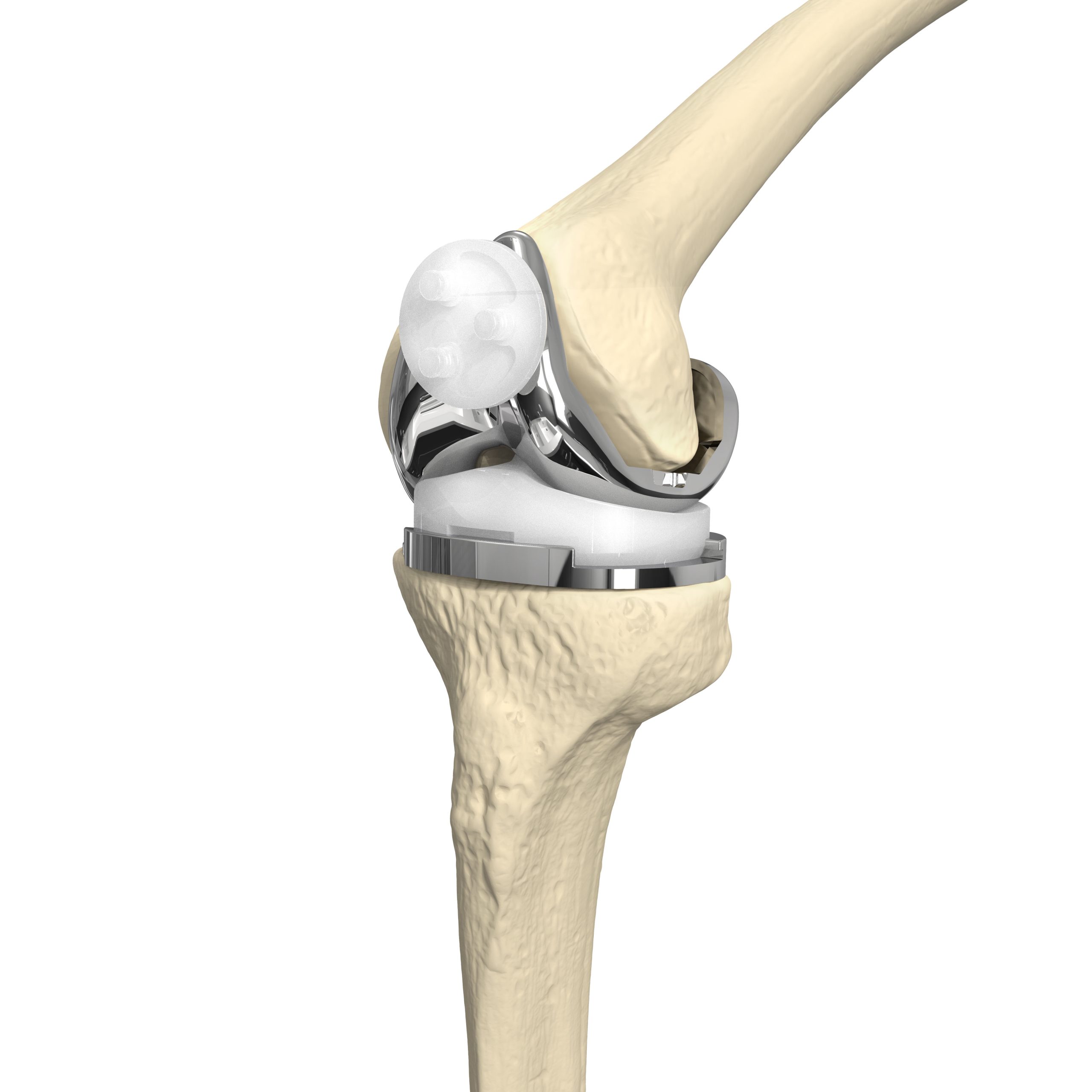 Artificial knee joint arthroplasty components